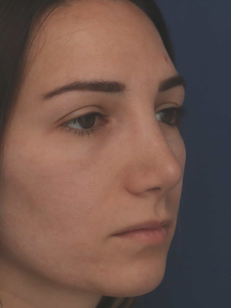 After Image: Rhinoplasty - left-front-oblique