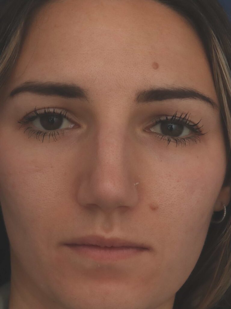 Before Image: Rhinoplasty - front