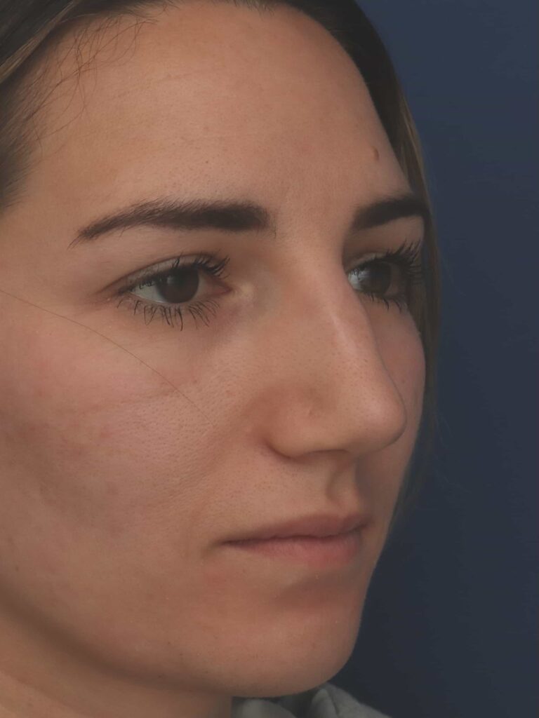 Before Image: Rhinoplasty - left-front-oblique