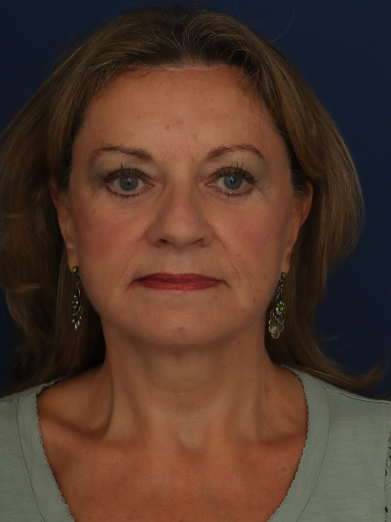 After Image: Facelift - front