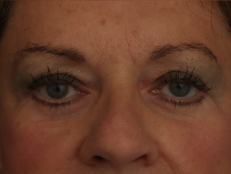 After Image: Facelift - front