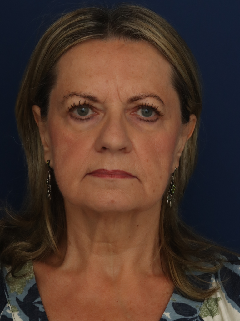 Before Image: Facelift - front
