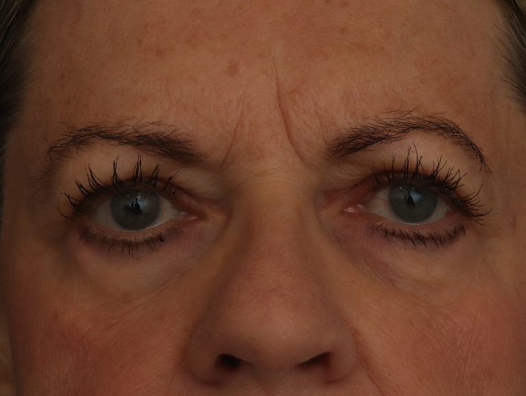 Before Image: Facelift - front