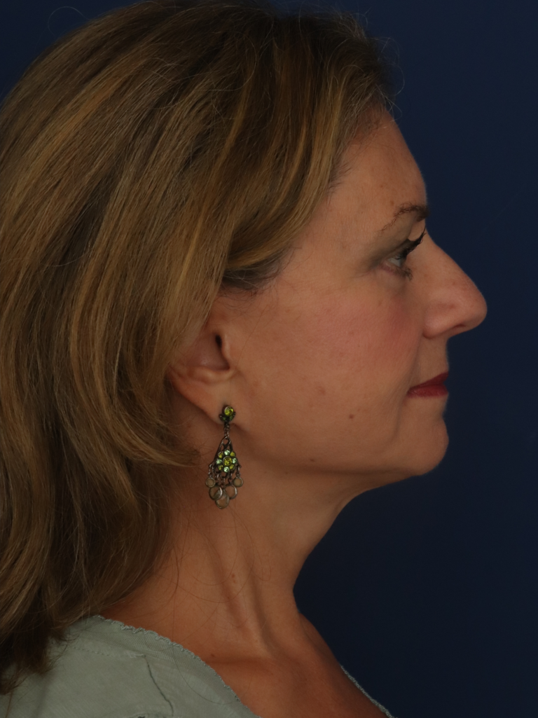 After Image: Facelift - right-side