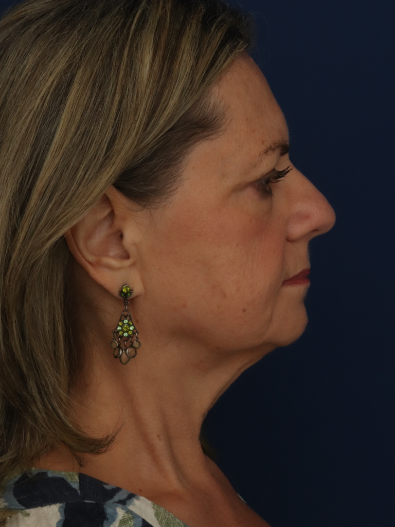 Before Image: Facelift - right-side
