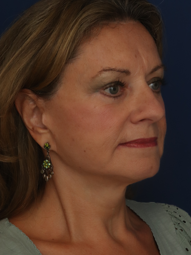 After Image: Facelift - right-front-oblique