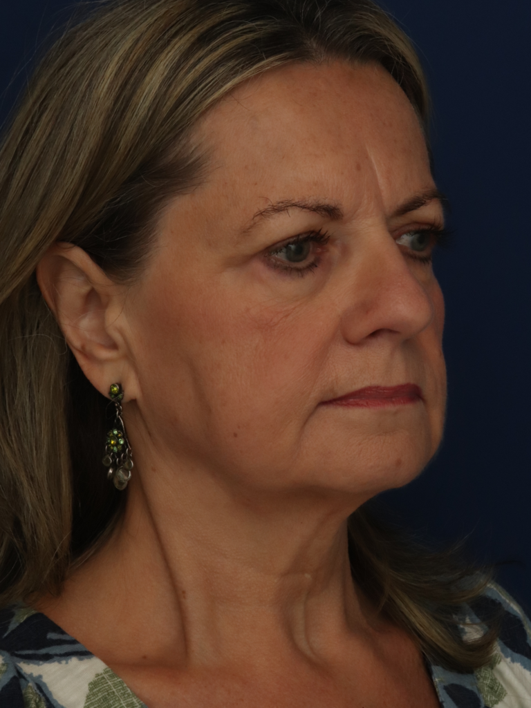 Before Image: Facelift - right-front-oblique