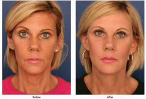 Before and after photos of woman after facelift.