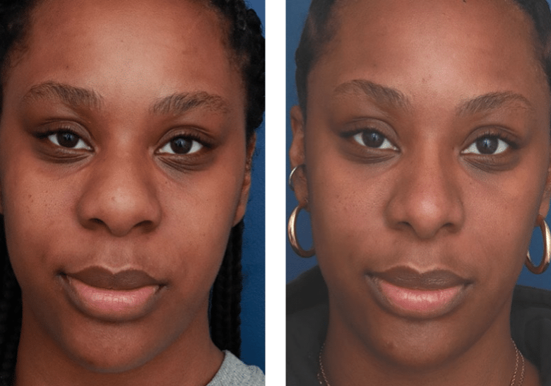 forward view of before and after rhinoplasty