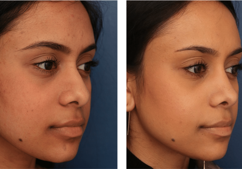 three quarter view of before and after rhinoplasty