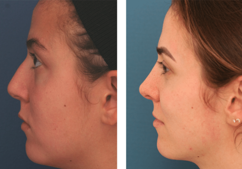 profile view of before and after rhinoplasty