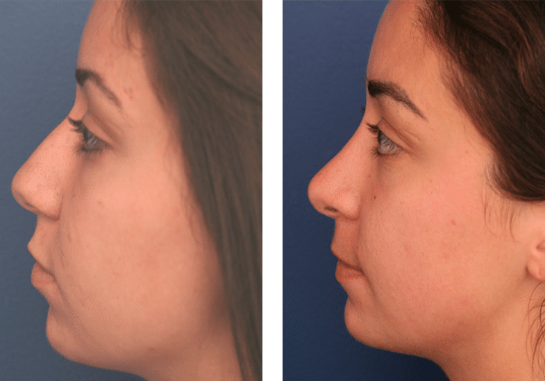 profile view of before and after rhinoplasty