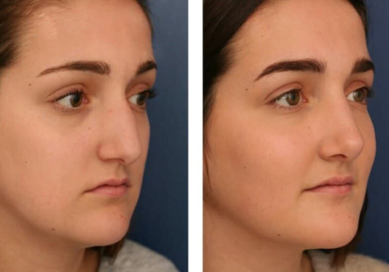 three quarter view of before and after rhinoplasty