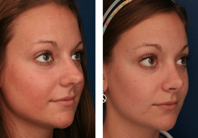 three quarter view of before and after rhinoplasty