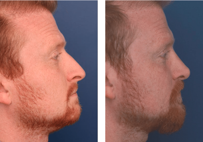 profile view of before and after rhinoplasty